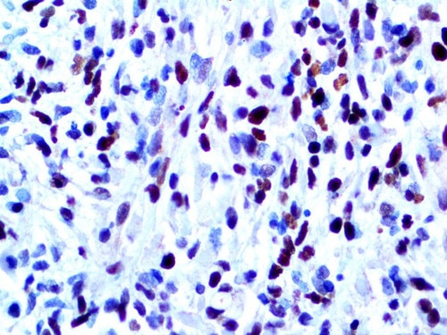 IHC of MyoD1 on an FFPE Rhabydomyosarcoma Tissue